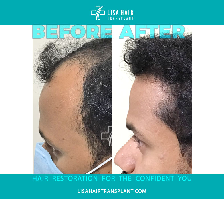 Lisa Hair Clinic offering high quality natural Hair restoration